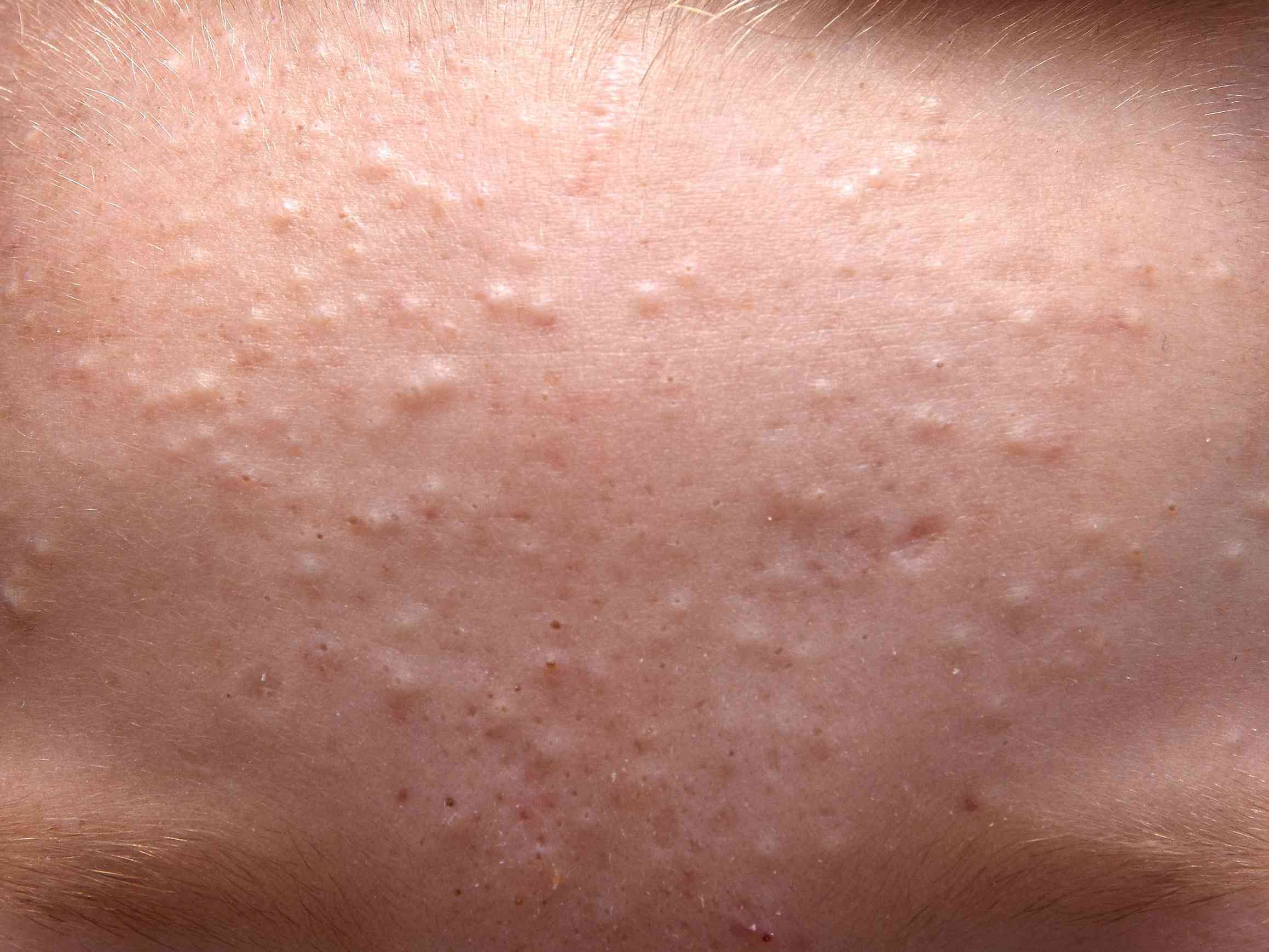 acne-001-bdc0402fa448416b85e95f1cbc5c9cea